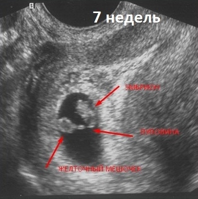 Фото УЗИ 7 неделя беременности