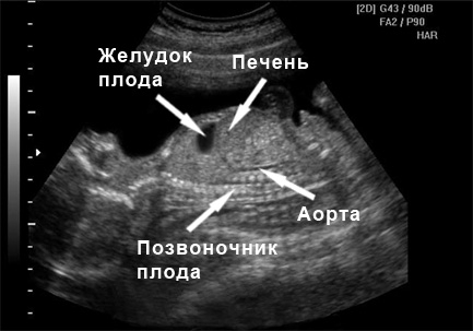 Фото УЗИ 23 неделя беременности