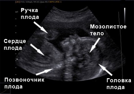Фото УЗИ 25 неделя беременности