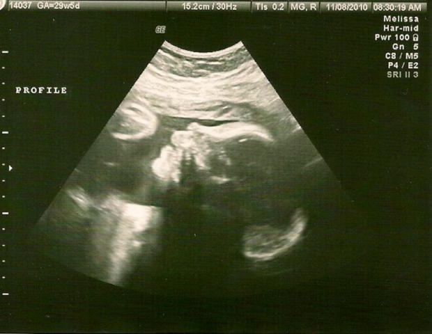 Фото УЗИ 29 неделя беременности