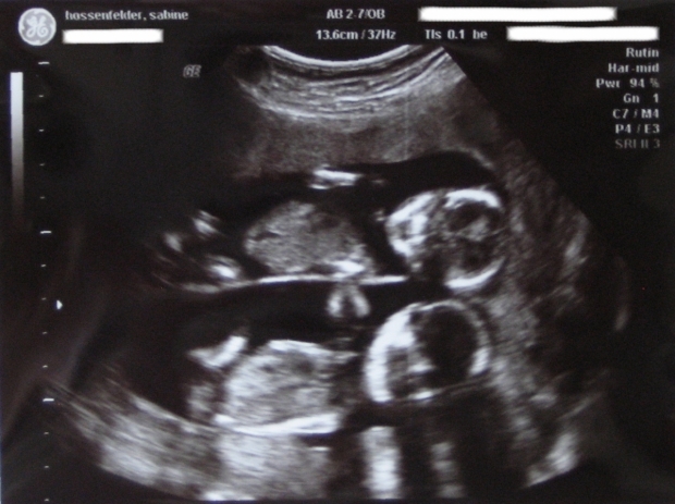 Фото УЗИ на 25 неделе беременности